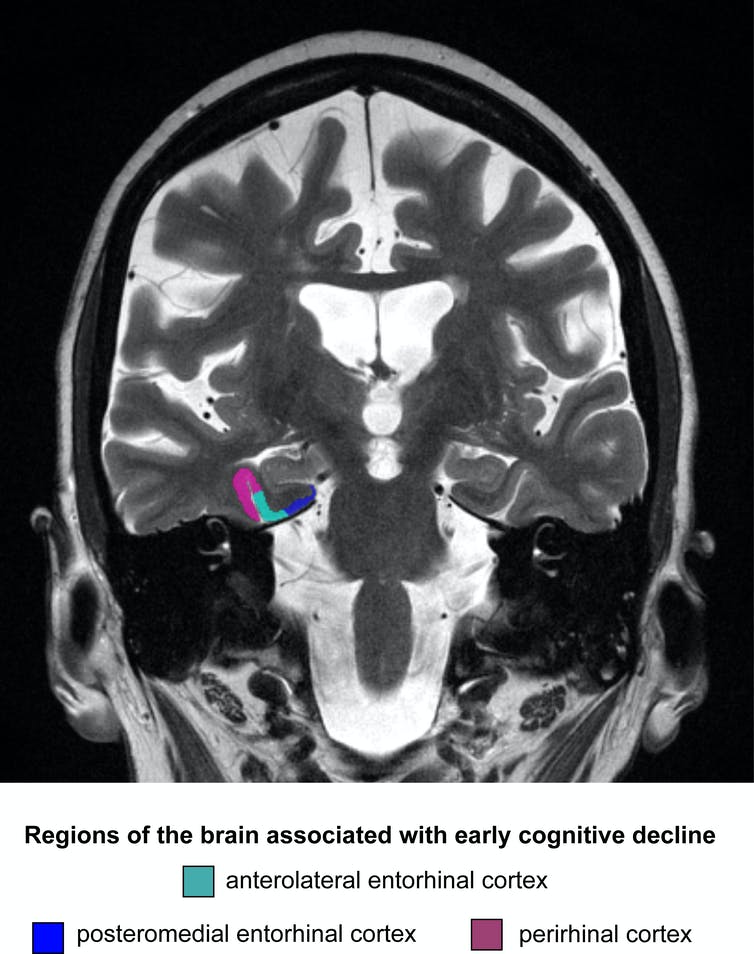 Image of brain with regions of the medial temporal lobe colour-coded (provided by author)